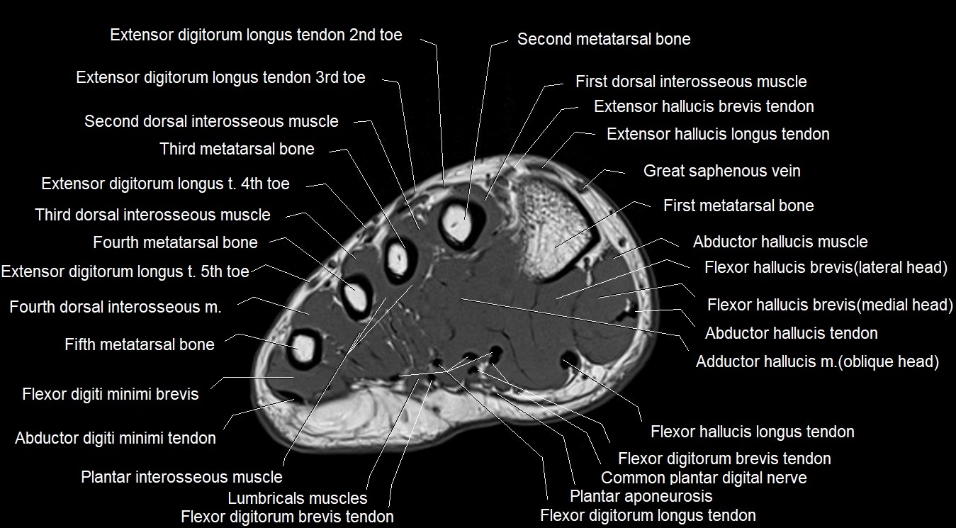MRI 3T foot axial cross sectional anatomy image 17.webp
